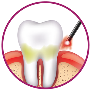 laser dentistry